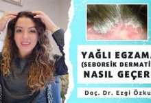 Seboreik Dermatit Hastalığı Nedir, Tedavisi Nasıl Yapılır?