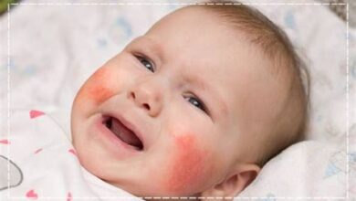 Bebeklerde Alerji Belirtileri ve Önlemleri